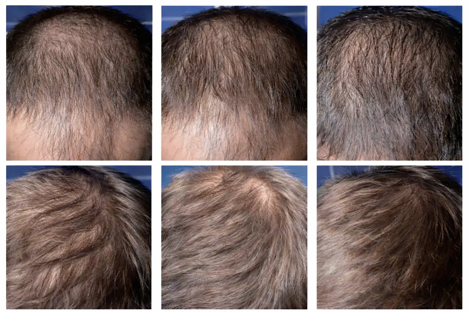 Резултати от мезотерапия